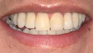 chipped-tooth-after-02
