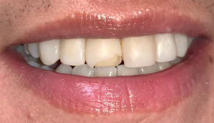 chipped-tooth-before-02